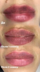 Удаление татуажа губ ремувером в студия Yuliana-Permanent в Киеве