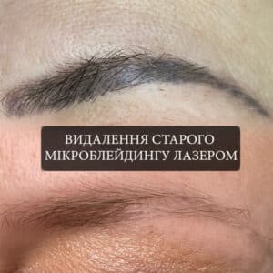 1udalenie-tatuazha Yuliana-Permanent