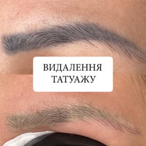 2 udalenie-tatuazha Yuliana-Permanent