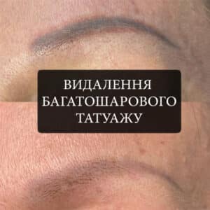 3 udalenie-tatuazha Yuliana-Permanent
